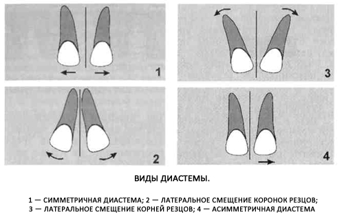 Диастема